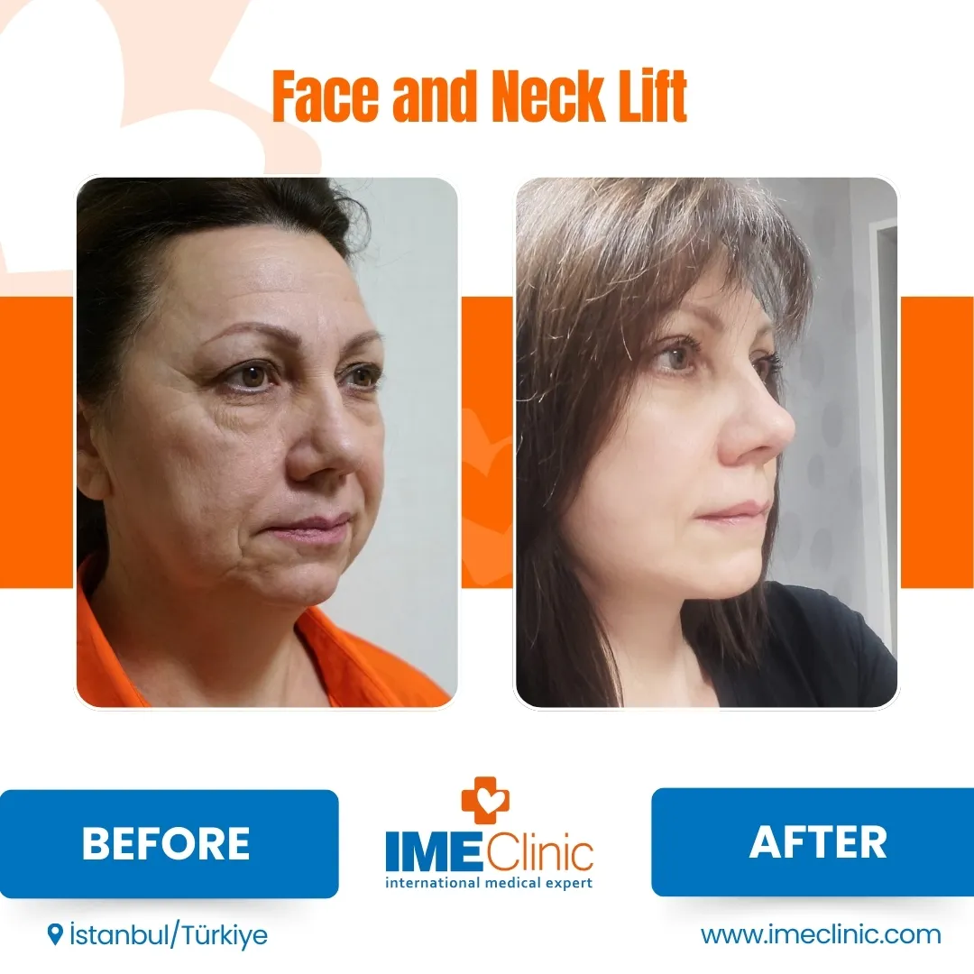 Before Blepharoplasty Turkey and SMAS Lifting Turkey Procedure