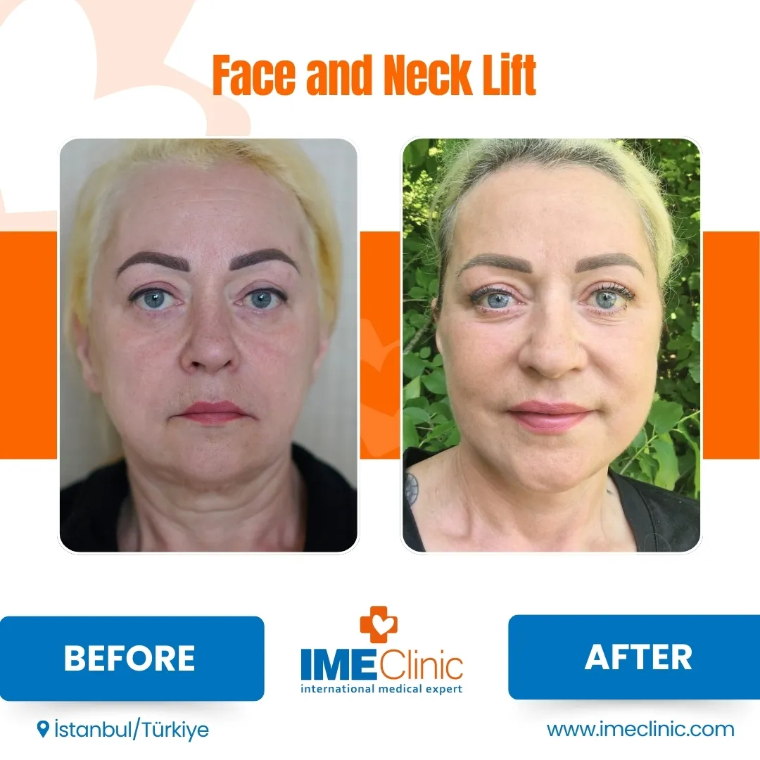After Mid Face Lift Turkey and Blepharoplasty Turkey Results