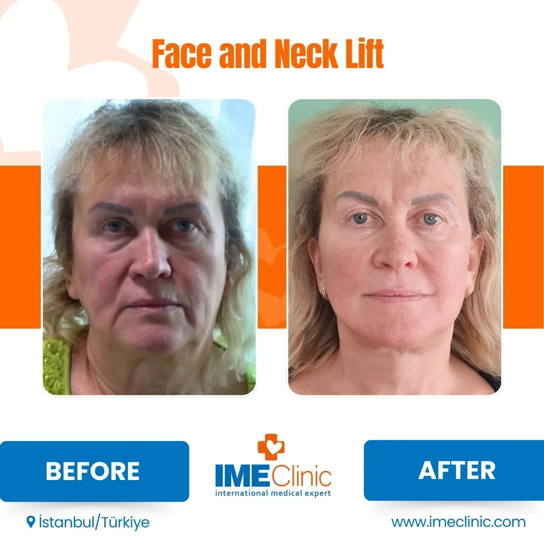 Before SMAS Lifting Turkey and Mid Face Lift Turkey Treatment