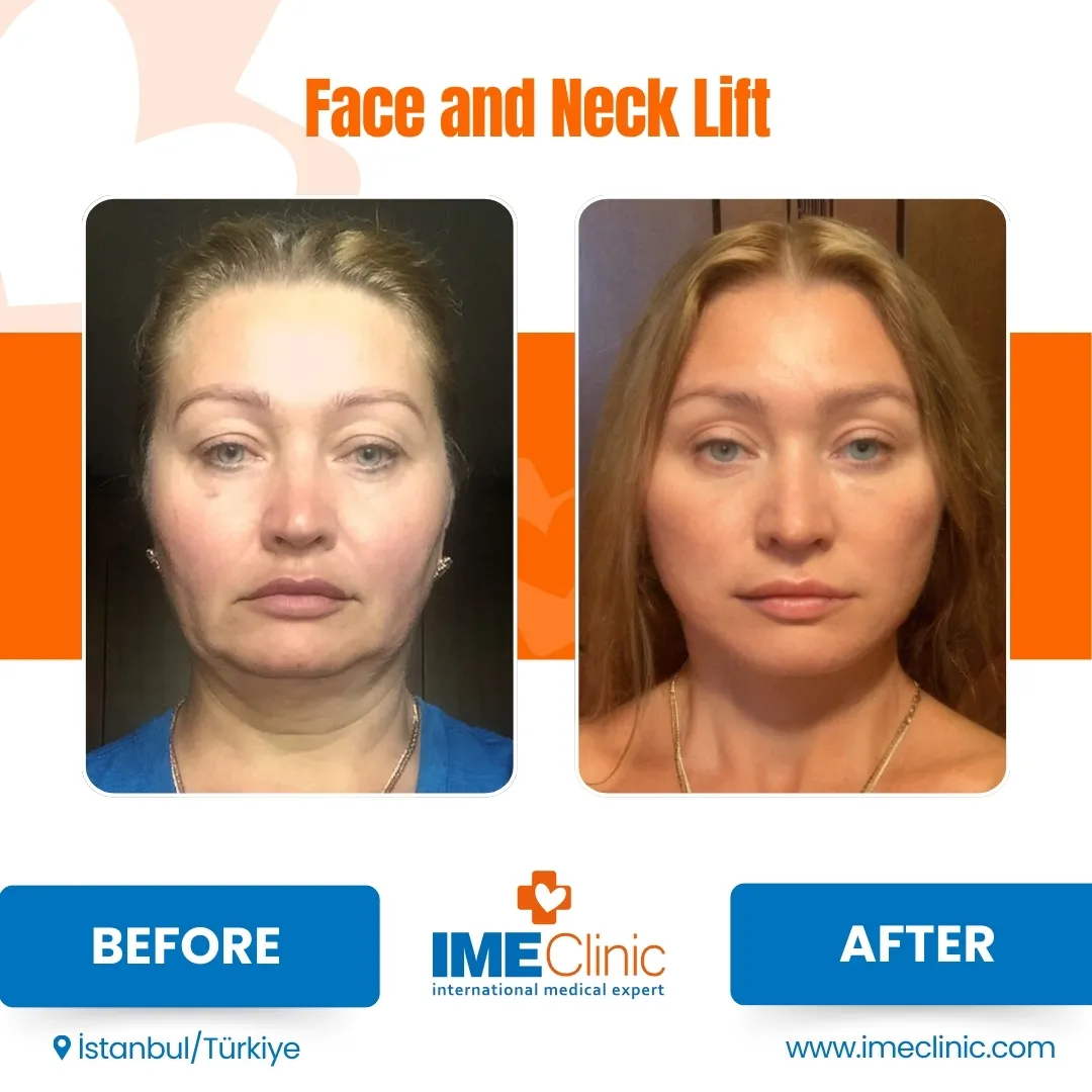 After Blepharoplasty Turkey and SMAS Lifting Turkey Transformation