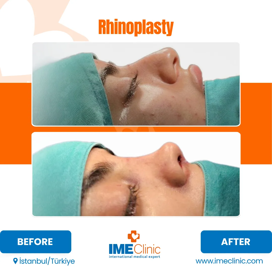 Two side-by-side photos show a persons face before and after rhinoplasty surgery, highlighting changes in the nose profile. The patient is lying down, wearing a green surgical cap and drape.