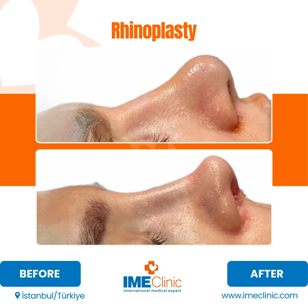 Side-by-side before-and-after photos show a young person’s profile, highlighting changes to the shape of their nose following rhinoplasty surgery. The background is blue, and clinic details are at the bottom.