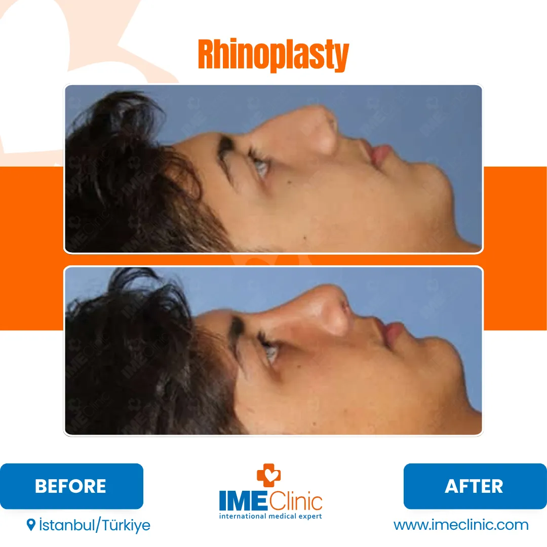 Side-by-side before and after images show a person’s profile before and after rhinoplasty, highlighting a straighter and more refined nose shape post-surgery. The clinic name and website are visible at the bottom.