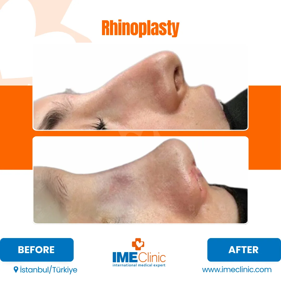 Side-by-side profile images of a persons nose before and after rhinoplasty; the before image shows a prominent nasal bridge, while the after image shows a straighter, smoother nose shape.
