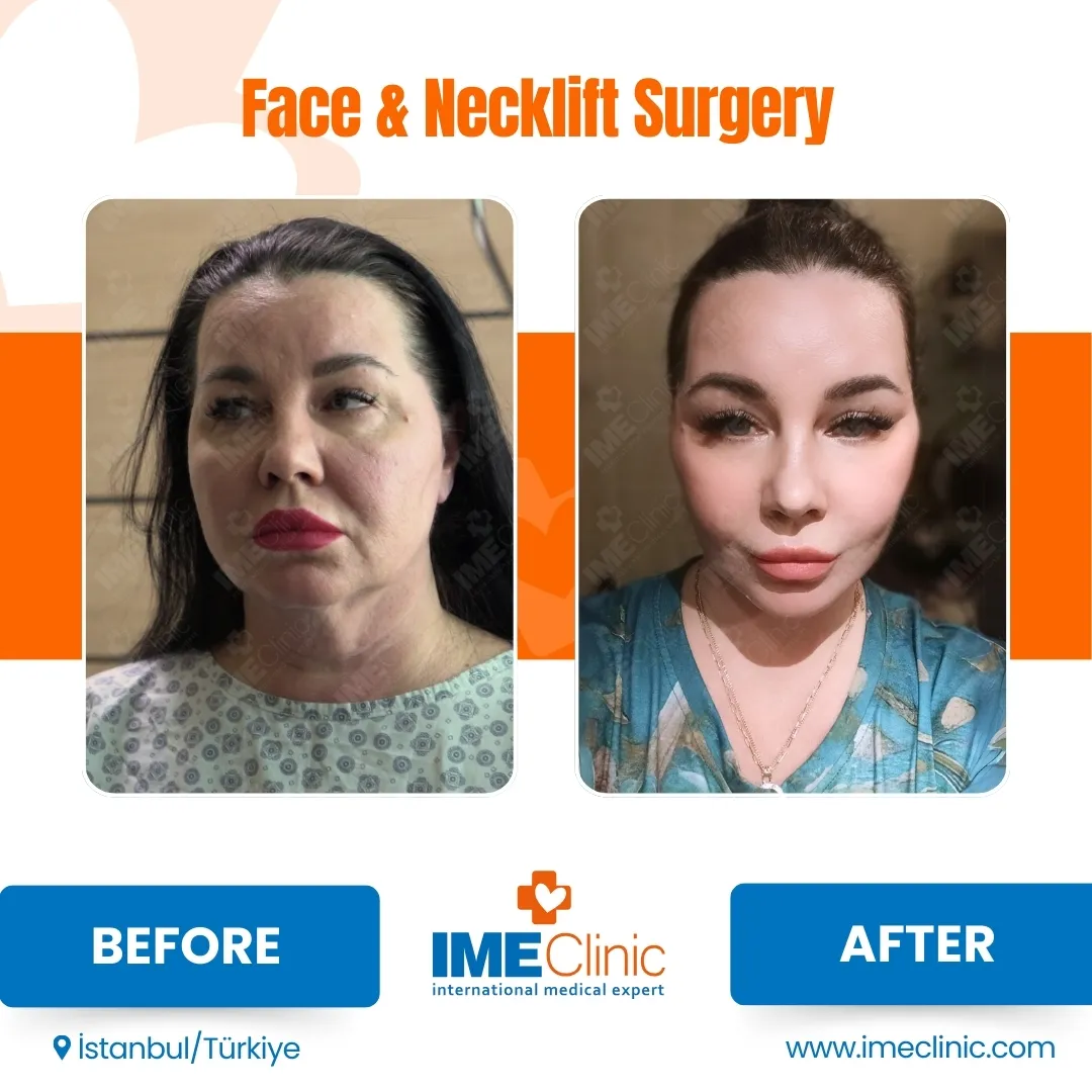 Before & After