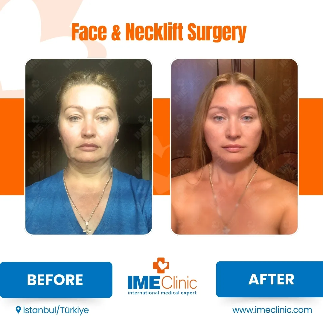 Before & After