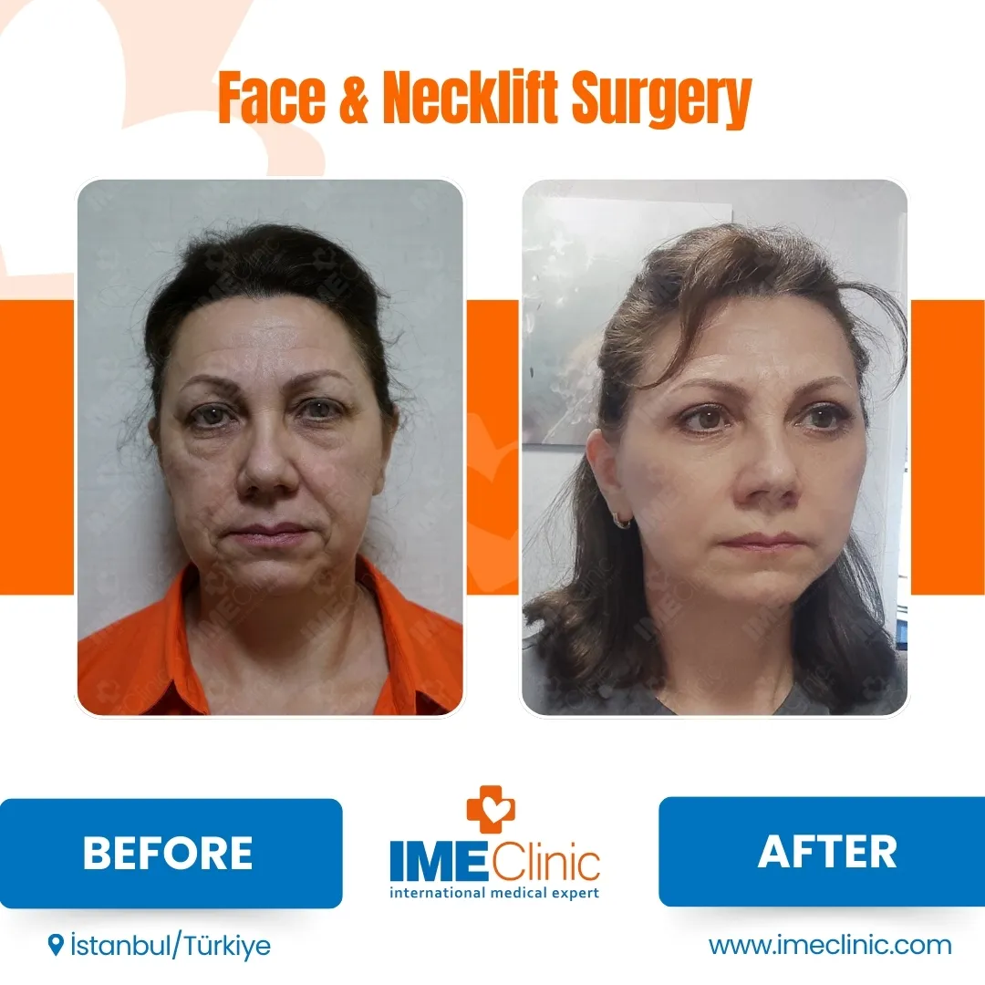 Before & After