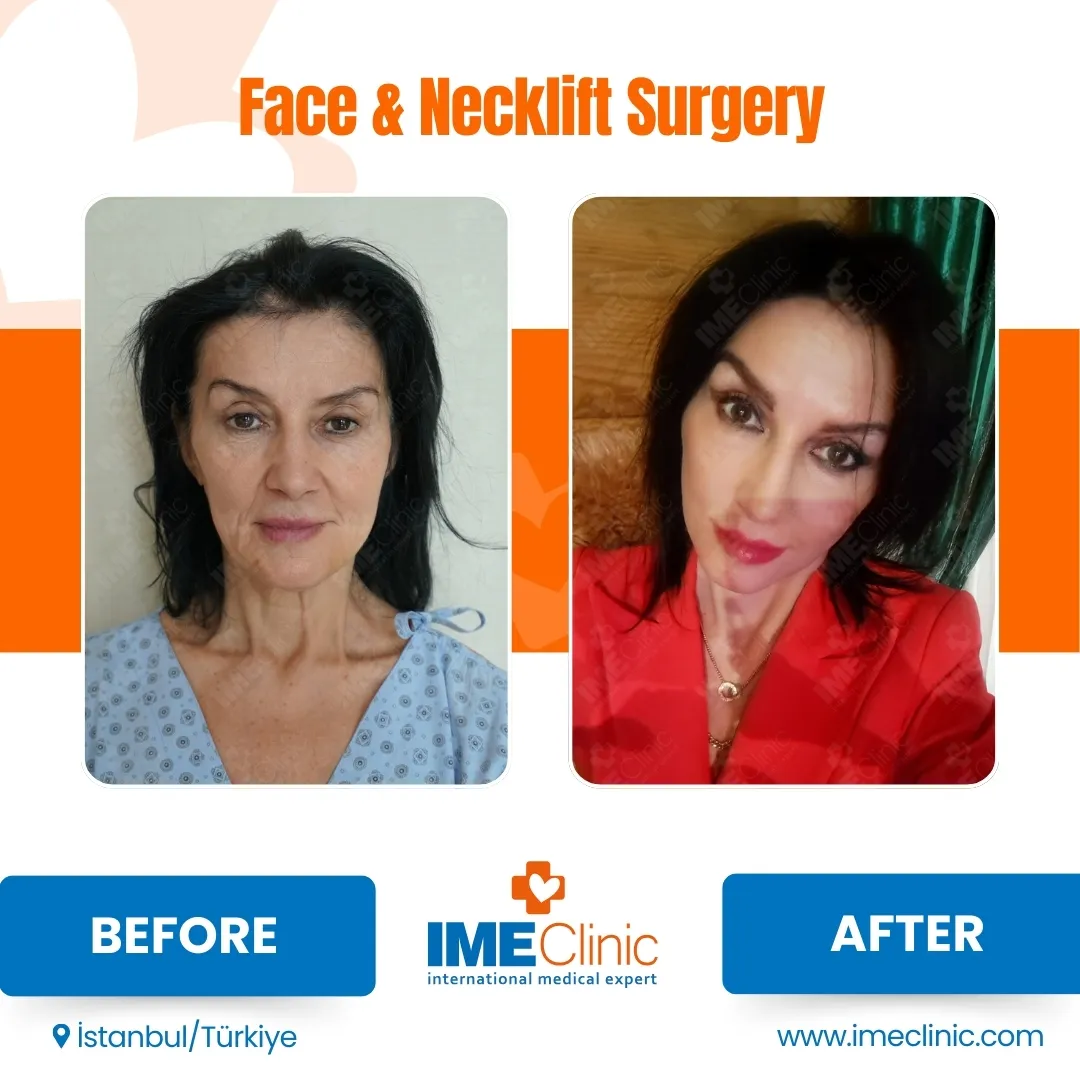 Before & After
