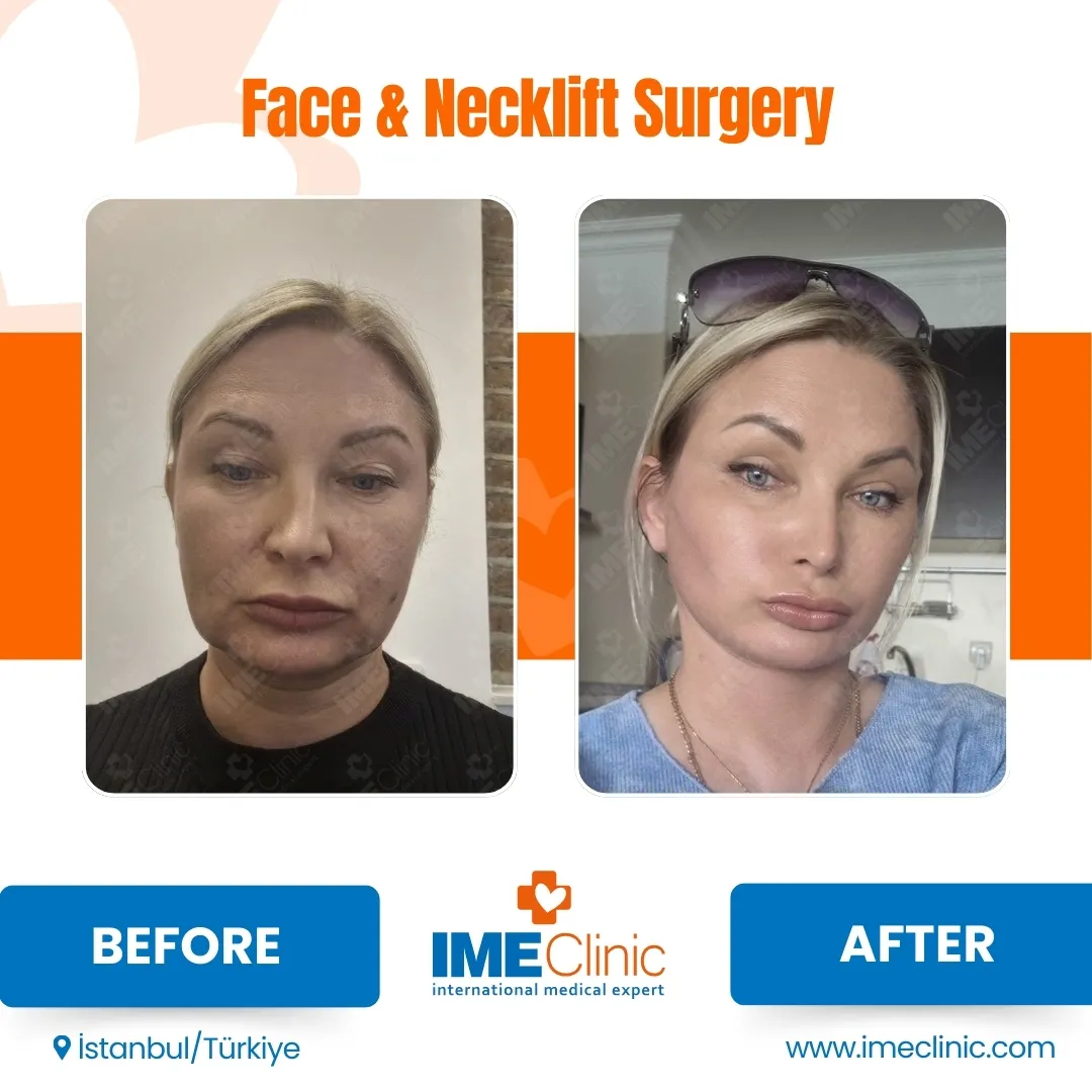 Before & After