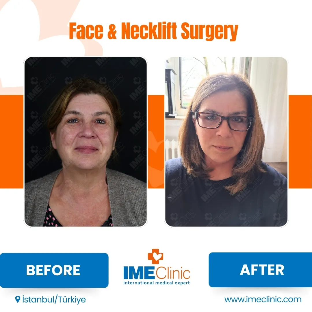 Before & After