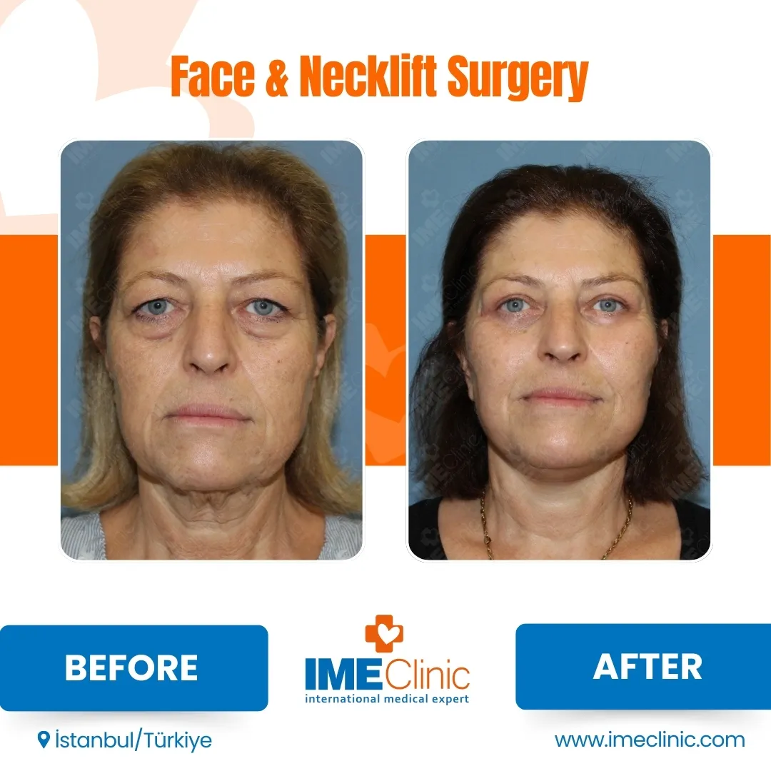 Before & After
