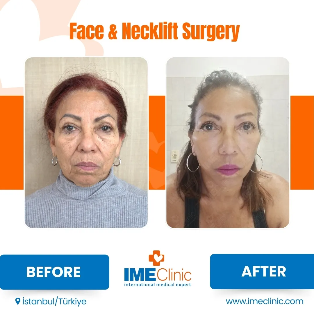 Before & After
