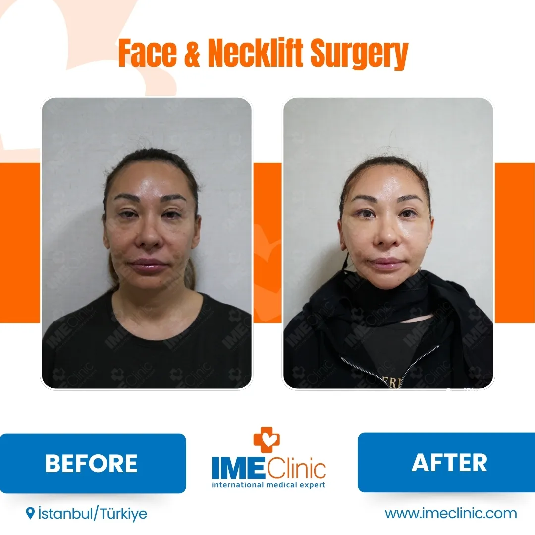 Before & After