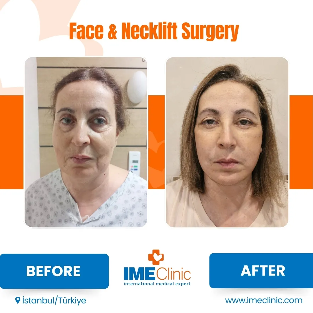 Before & After