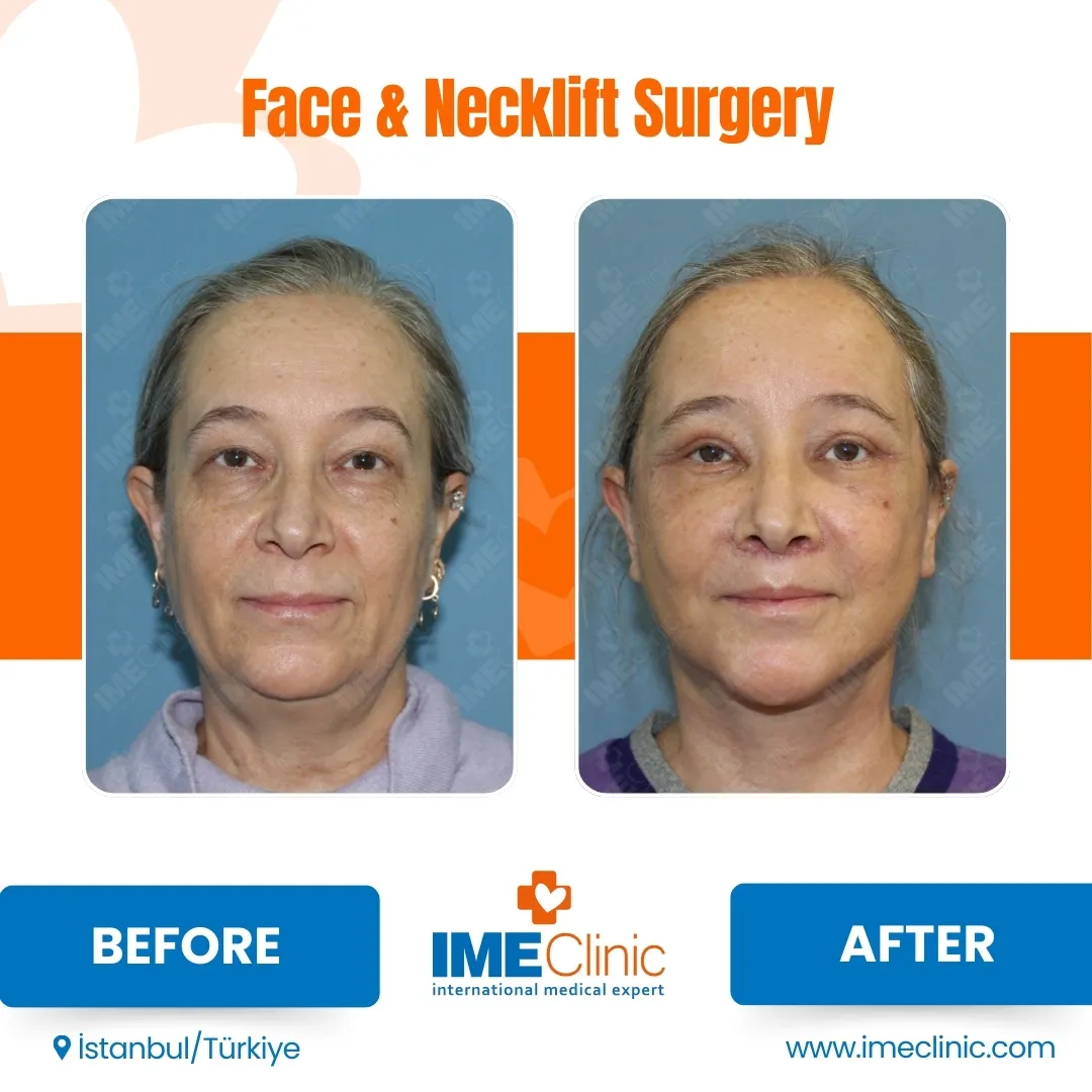 Before & After