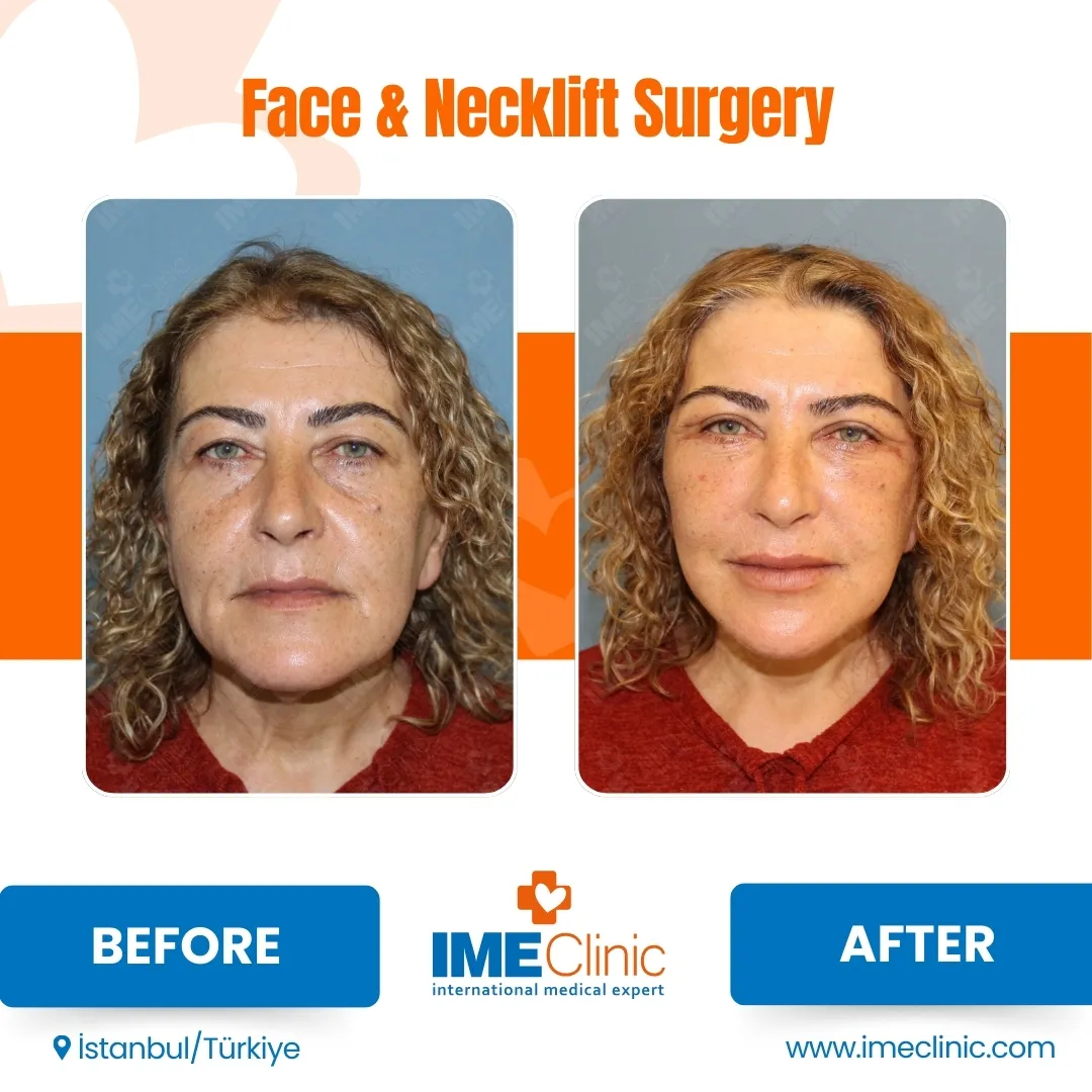 Before & After