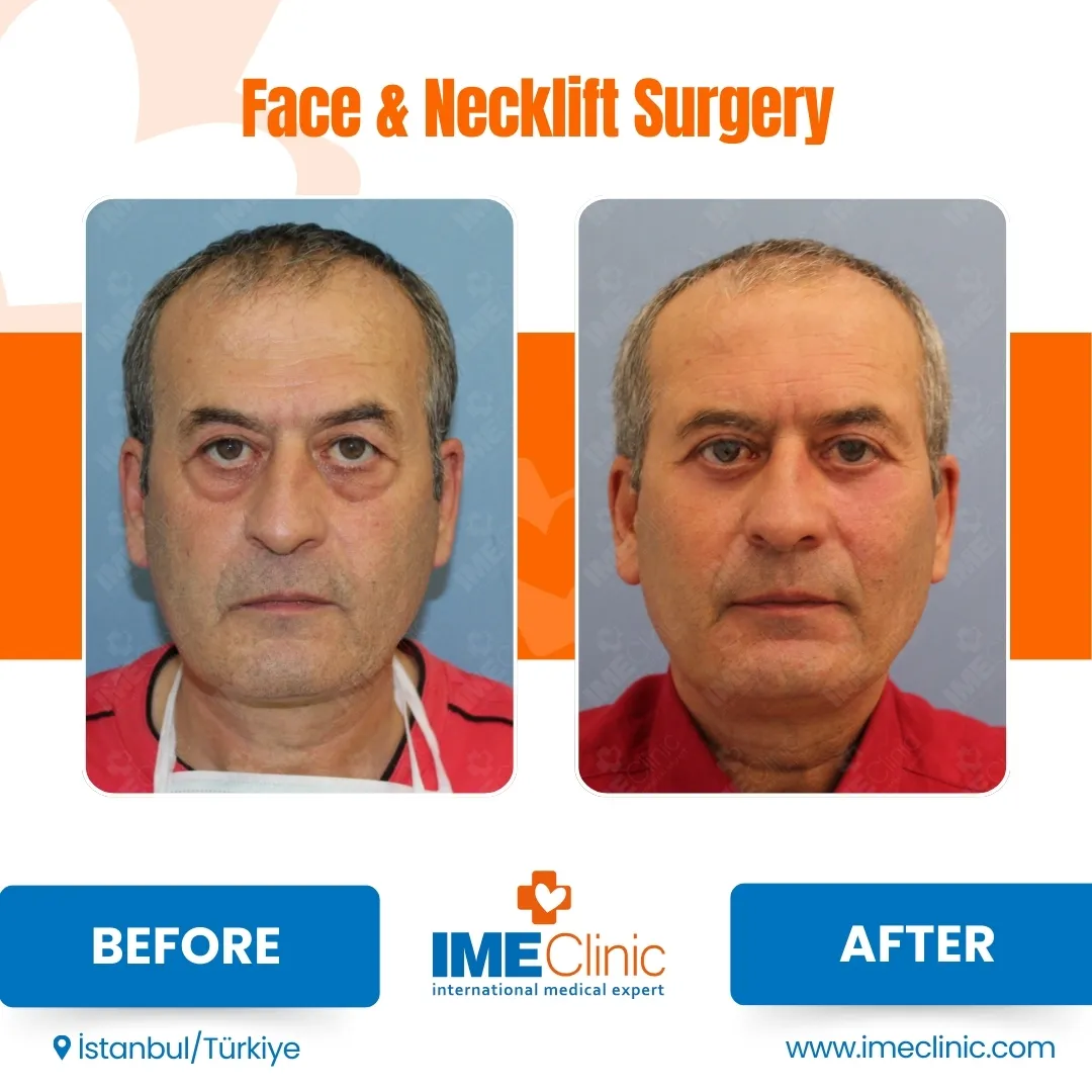 Before & After