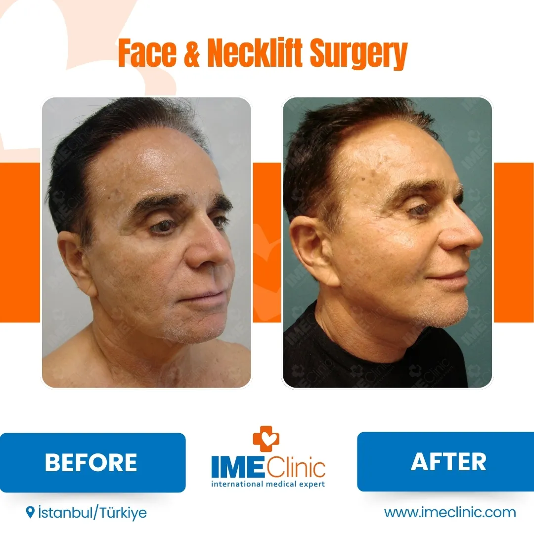 Before & After