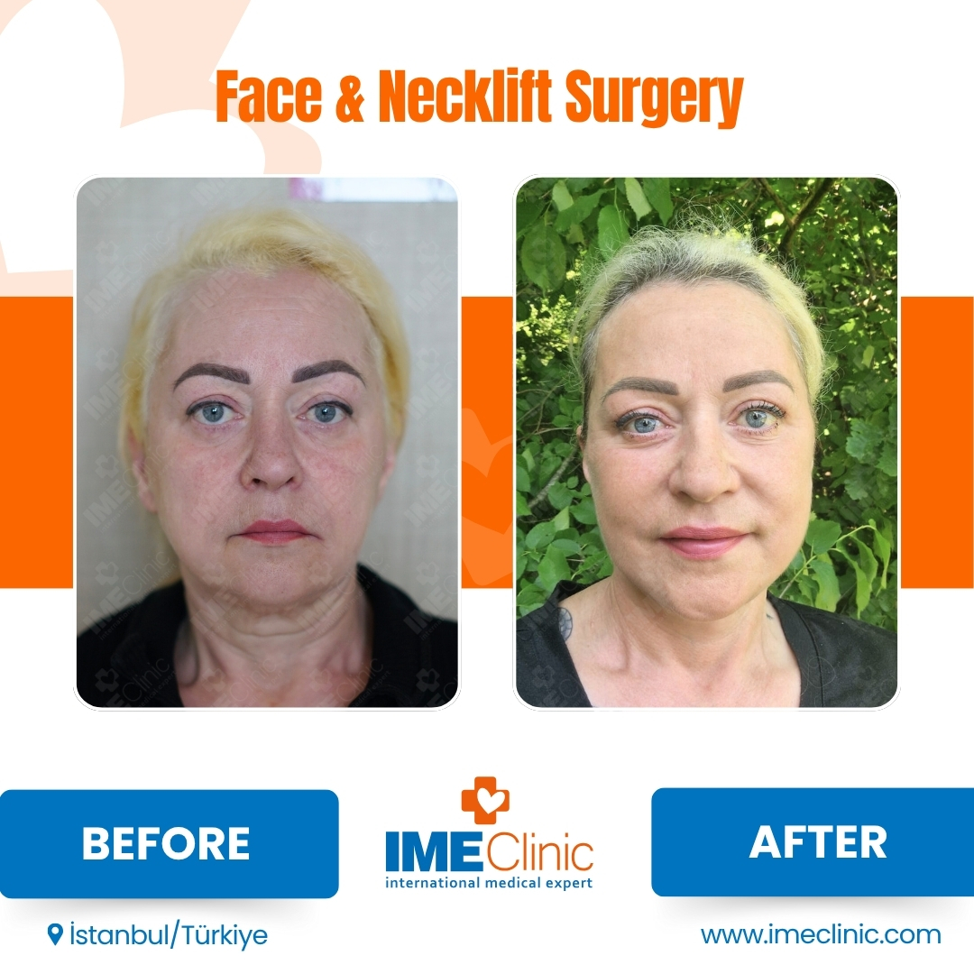 Before & After